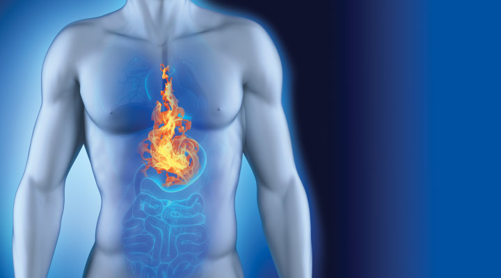 acid-reflux-diagram